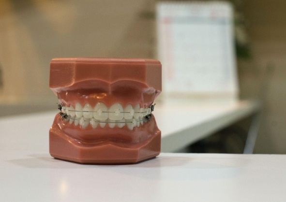 矯正の歯型
